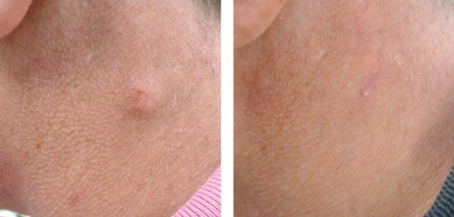 Cyst Removal Cost Near Me: How Prices Vary by Location in 2026